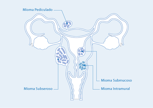 NT_Mapa _Miomas (1)