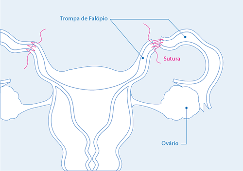 NT_Mapa _Reversao Laqueac ̧a ̃o (1)